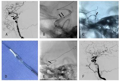 Procedure-Related Complication of Willis Covered Stent in the Treatment of Blood Blister-Like Aneurysm: Stent Detachment from Dilating Balloon